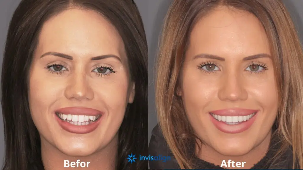 Side-by-side photo of a woman before (left) and after (right) Invisalign treatment, smiling to show improved tooth alignment and a brighter smile.