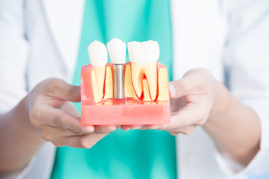 Dental implant model showing a screw-type implant replacing a missing tooth, held by gloved hands in a clinical setting.